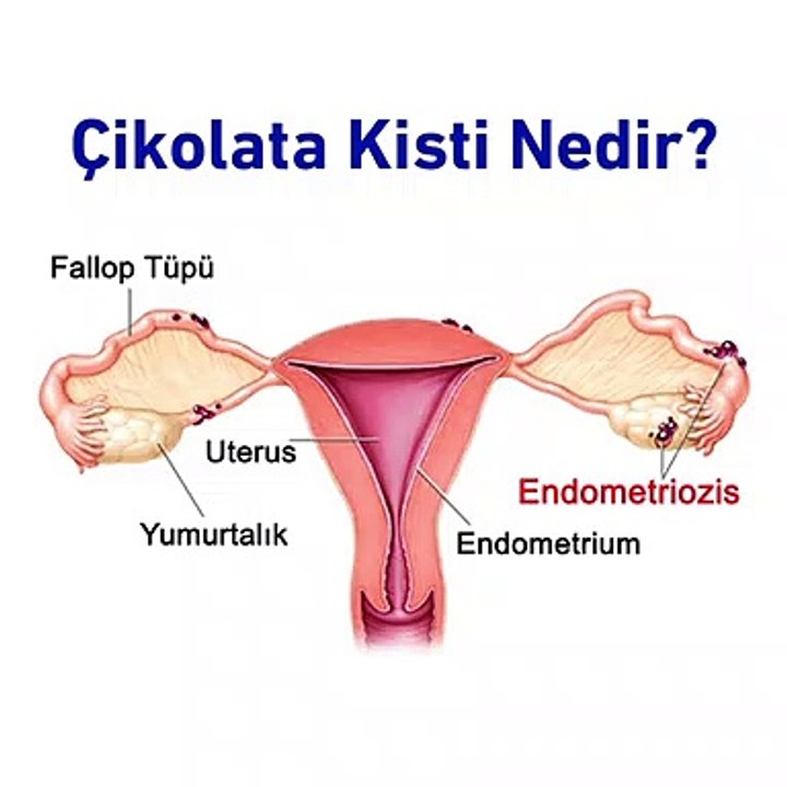 Çikolata kisti nedir? - www.irfantarhan.com