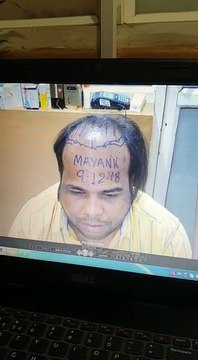 Hair Transplant Review at Sai Cosmetics | The Trusted Hair Transplant Clinic in Pune