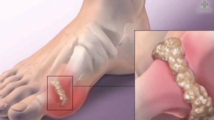 How To Cure Uric Acid Naturally