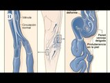 Riesgos y peligros que provocan las varices