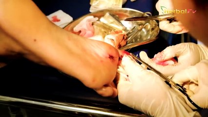 Batuk Sembuh, Dahak Serta Lendir Paru paru Hilang Dengan Bahan Alami Berikut