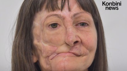 Le visage de cette Brésilienne a été reconstruit grâce à un smartphone et une imprimante 3D