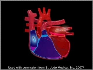 Life Line Screening - A-Fib and Stroke Animation