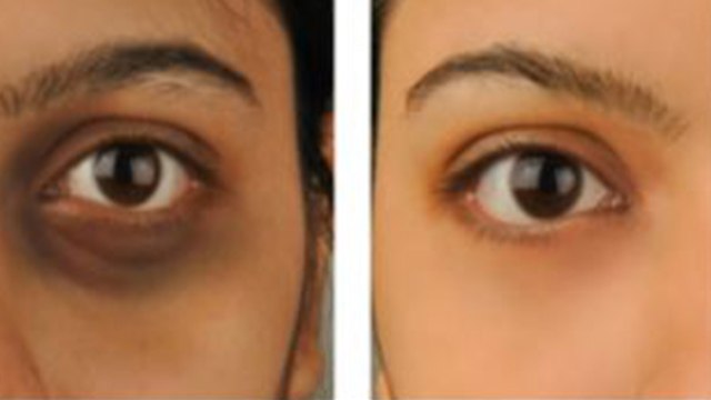 आंखों के काले घेरे | Best food to get rid of Dark Circles | Dark Circle Natural Treatment | Boldsky
