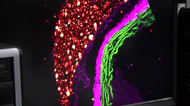 혈관 외벽 변화 측정...동맥경화 정확도 높인다 / YTN