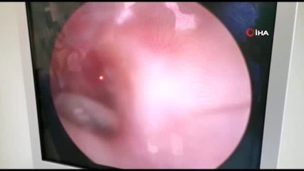 Kaşıntı ve ağrı şikayetiyle hastaneye giden adamın kulağından sinek lavraları çıktı