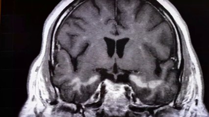 Amnesia: Síndrome de la Guerra del Golfo