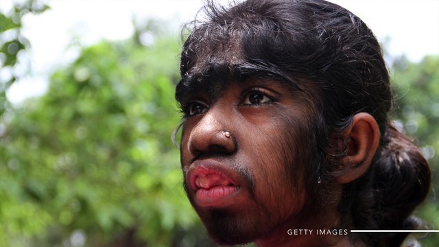 17 bebés contraen el síndrome del hombre lobo y les crece vello por todas partes