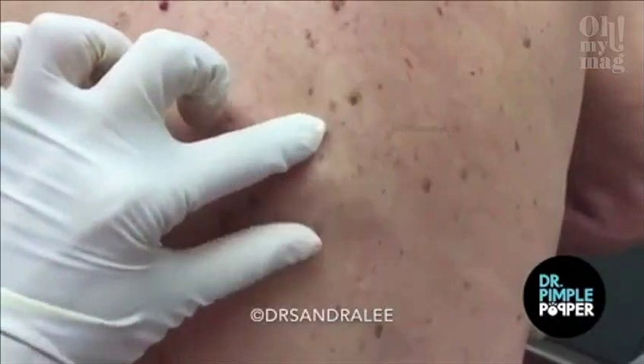 (VÍDEO) La doctora Lee explota un quiste que parece un volcán