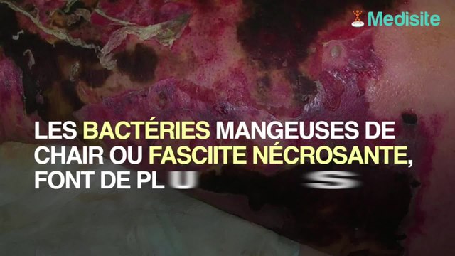 Victime de bactéries mangeuses de chair, il a perdu 25% de sa peau