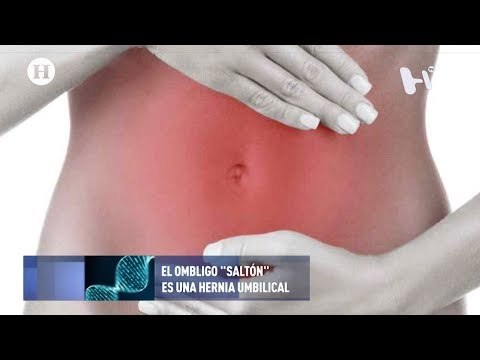 ¿Qué es y cómo se trata una hernia umbilical?
