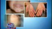 pamilyaonguard-HAND, FOOT AND MOUTH DISEASE COMMONLY AFFECTS BABIES, CHILDREN