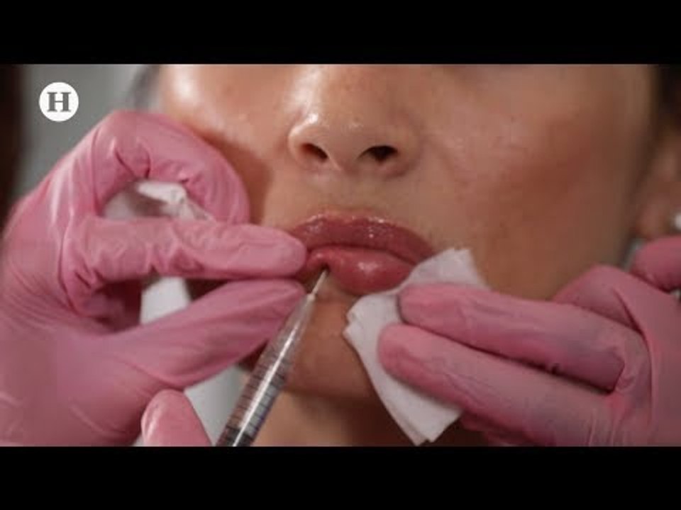 Rellenos faciales ¿cuales son los tratamientos seguros?