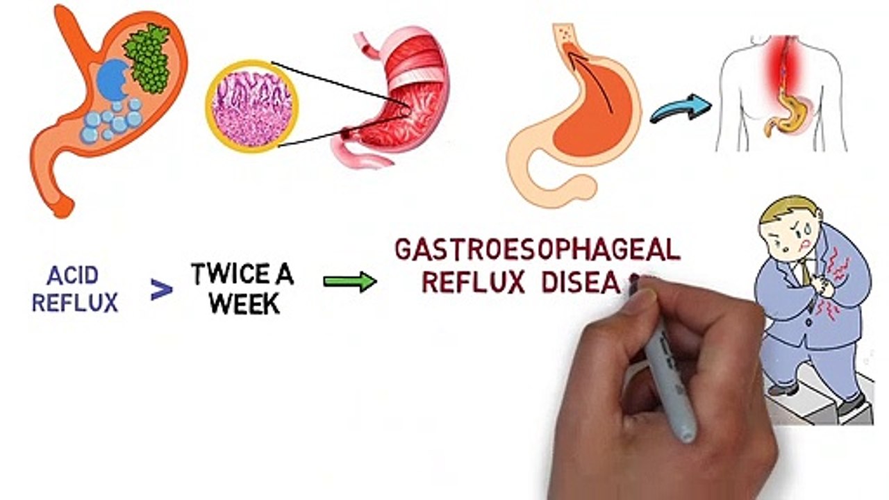 Acid Reflux, Heartburn - Explained
