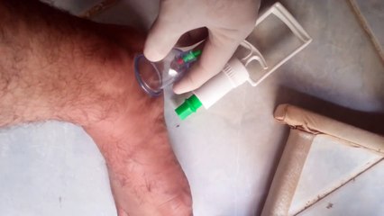 HACAMAT NASIL YAPILIR?/UYGULAMALI