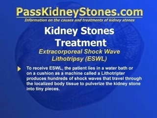 Extracorporeal Shock Wave Lithotripsy
