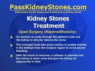 Open Surgery For Kidney Stones
