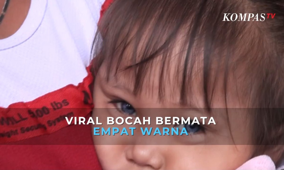 Viral! Bocah Berbola Mata Empat Warna