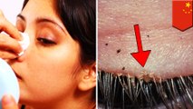 卸妝不徹底 愛美OL驚見眼睛螨蟲充斥