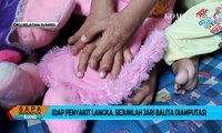 Idap Penyakit Langka, Sejumlah Jari Balita Terpaksa Diamputasi