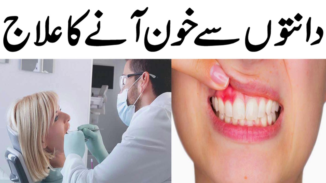 Teeth Blood Problem Solution in Urdu || Treatment Of Bleeding teeth || مسوڑھوں سے خون آنے کا علاج