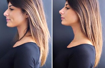 L'ex tronista Giulia Cavaglia ha un naso nuovo: ha fatto un rinofiller