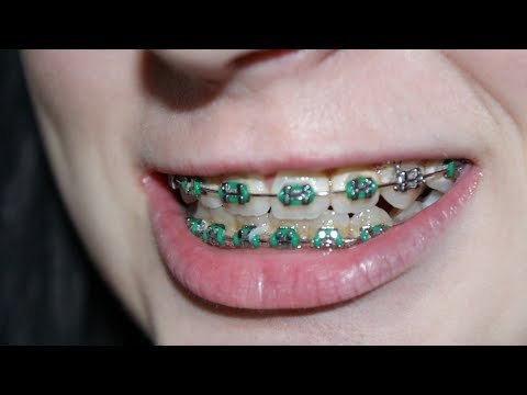 Mitos y realidades sobre los brackets