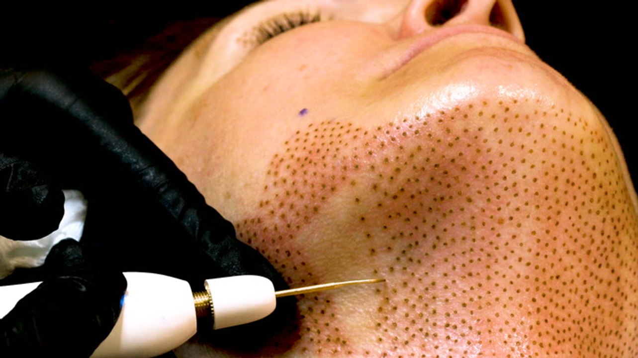 How a nonsurgical face-lift works