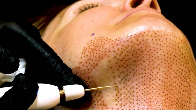 How a nonsurgical face-lift works