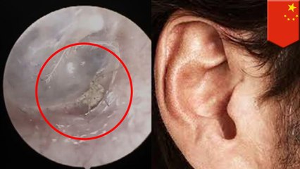 '한 남성, 귀가 간지러워 병원 갔더니, 거미가 거미줄치고 있어'외 10개