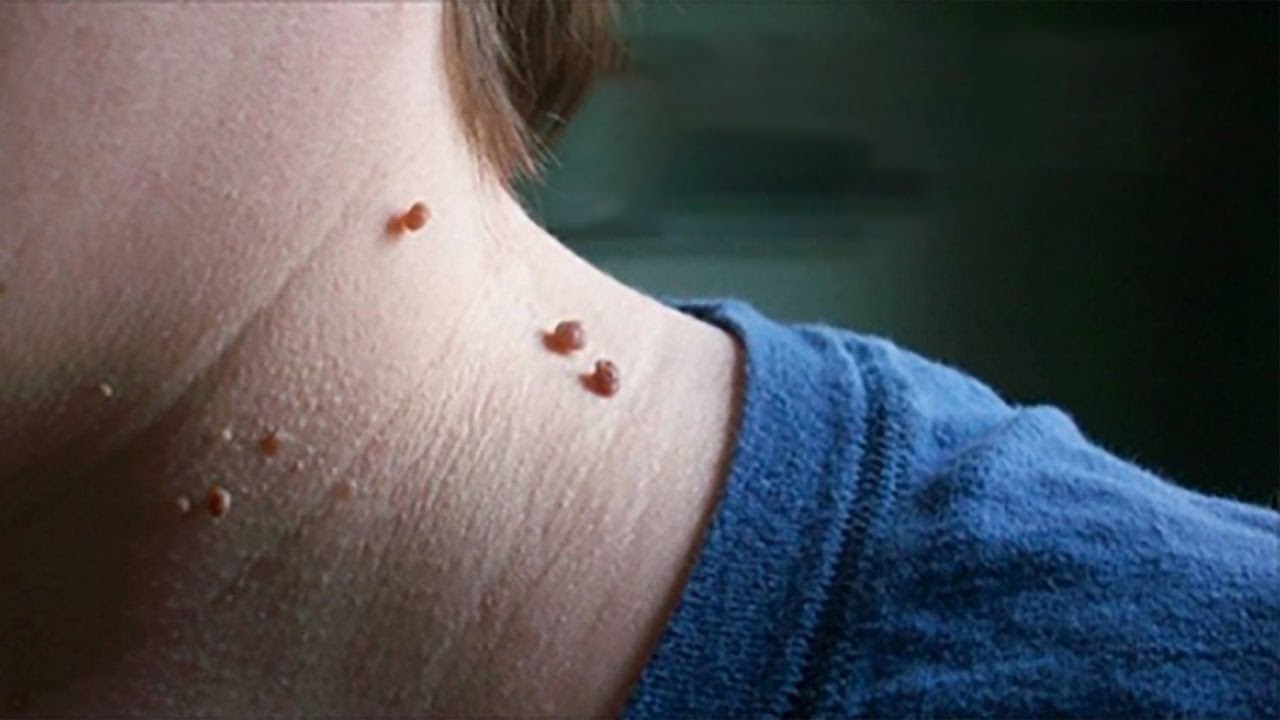 How to remove warts on face : மருவை அகற்ற இதை செய்யுங்கள்-வீடியோ
