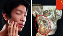 Sepelekan sakit gigi selama setahun, ada tumor di rahang remaja - TomoNews