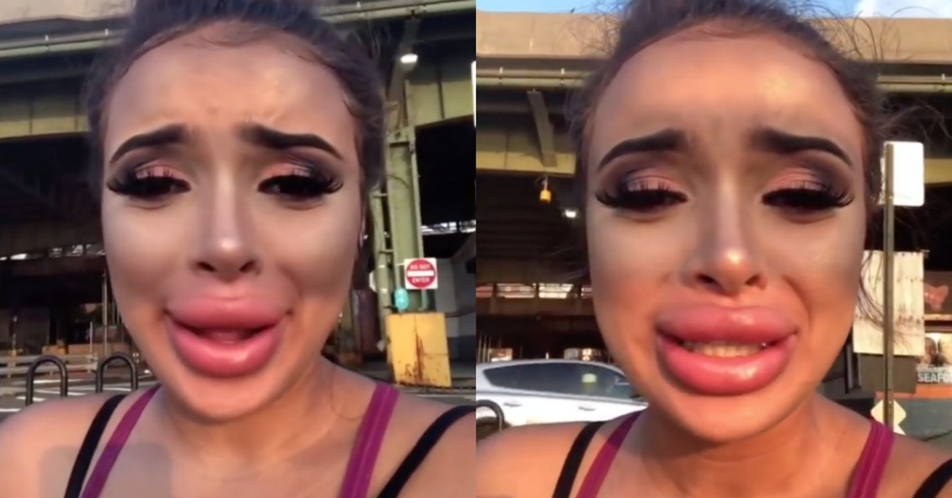 Quando a cirurgia plástica aos lábios não corre como esperado