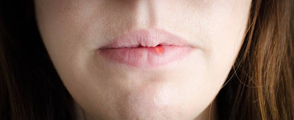 ¿Cómo eliminar rápidamente el herpes labial?