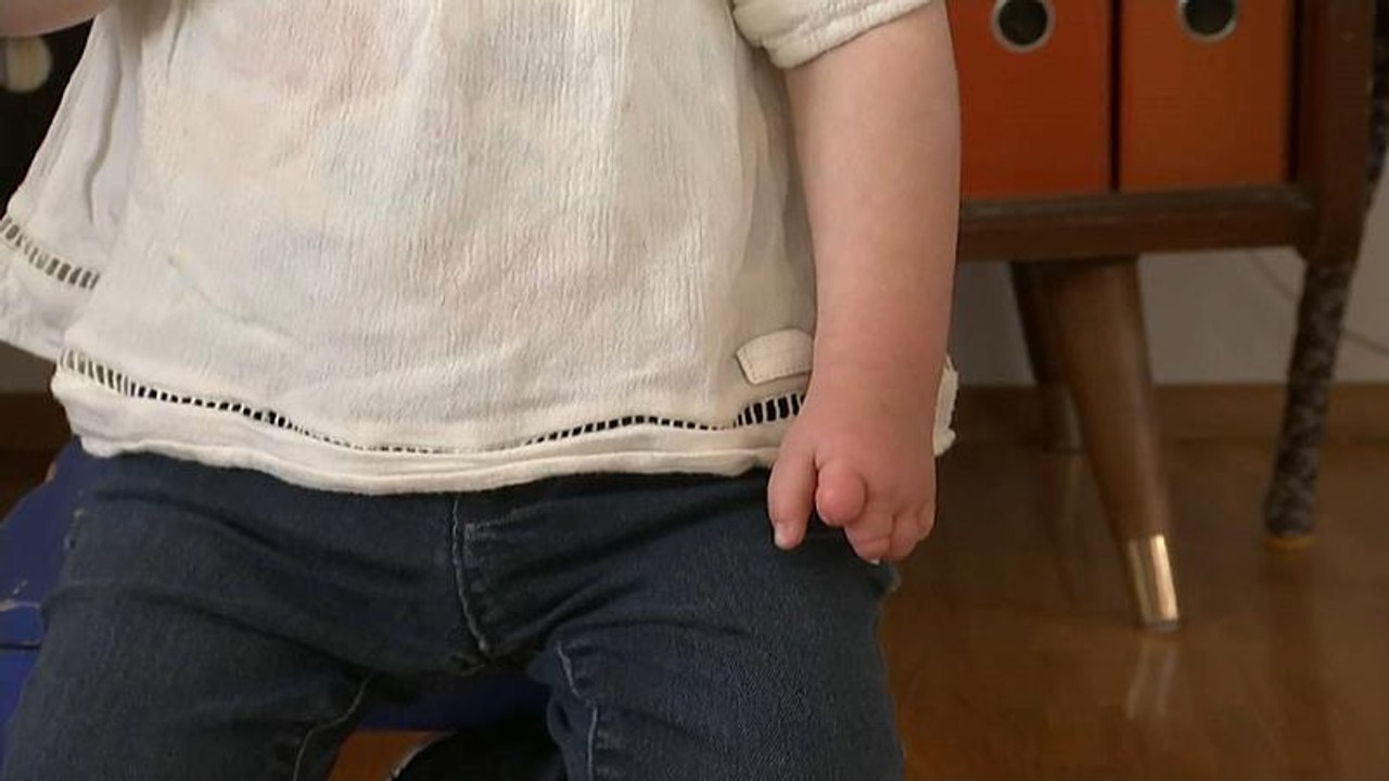 Wegen Handfehlbildung bei Babys: Ärzte fordern Register