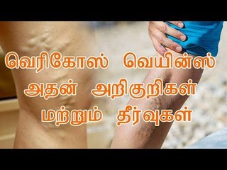 வெரிகோஸ் வெயின்ஸ் என்றால் என்ன? அதன் அறிகுறிகள் மற்றும் தீர்வுகள்