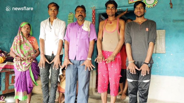 Family in India has bizarre trait where many have 12 finger or 14 toes