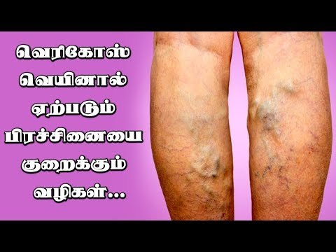 Varicose veins cause & How to prevent varicose veins ! |