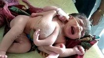 राजस्थान में जन्मा 4 हाथ वाला बच्चा, महिला के पेट में पल रहे थे तीन बच्चे, देखें वीडियो