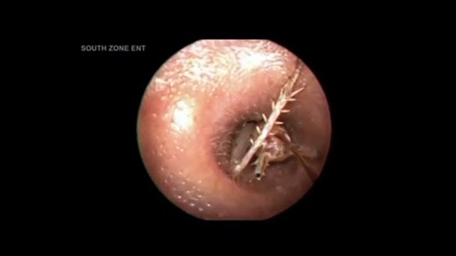 Il découvre un énorme insecte logé dans son oreille !