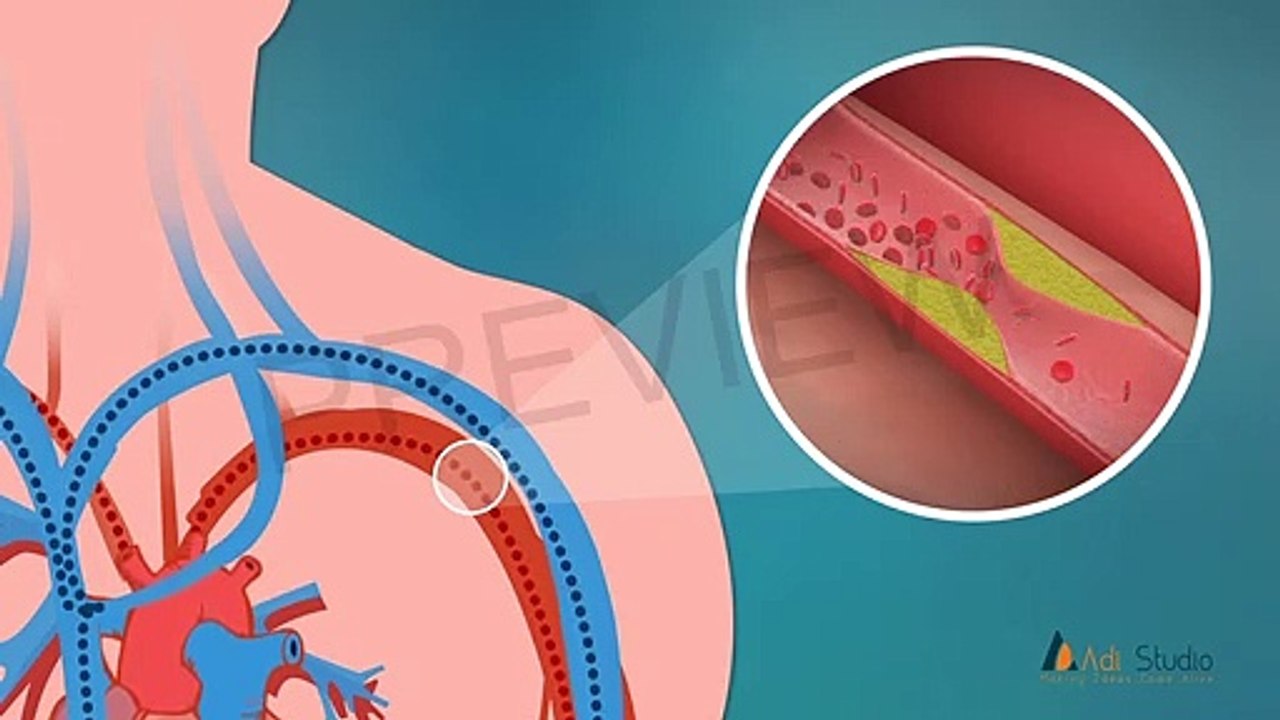 Blood Pressure Flow Animated Video Created By ADI Intellect - video ...