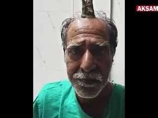 Un Indien de 74 ans qui se faisait appeler "l’homme licorne" à cause d’une excroissance sur le crâne a été opéré - VIDEO
