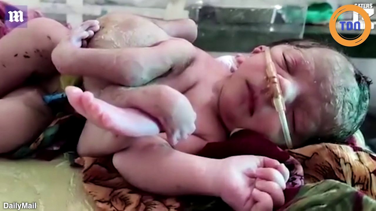 Inde : un bébé naît avec trois bras et quatre jambes ! - Vidéo Dailymotion
