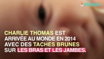 Elle pensait avoir des taches de naissance, c'était une tumeur au cerveau