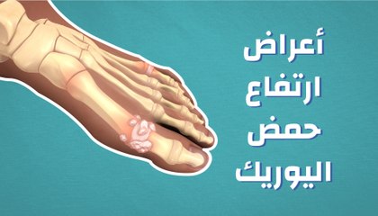 أعراض ارتفاع حمض اليوريك