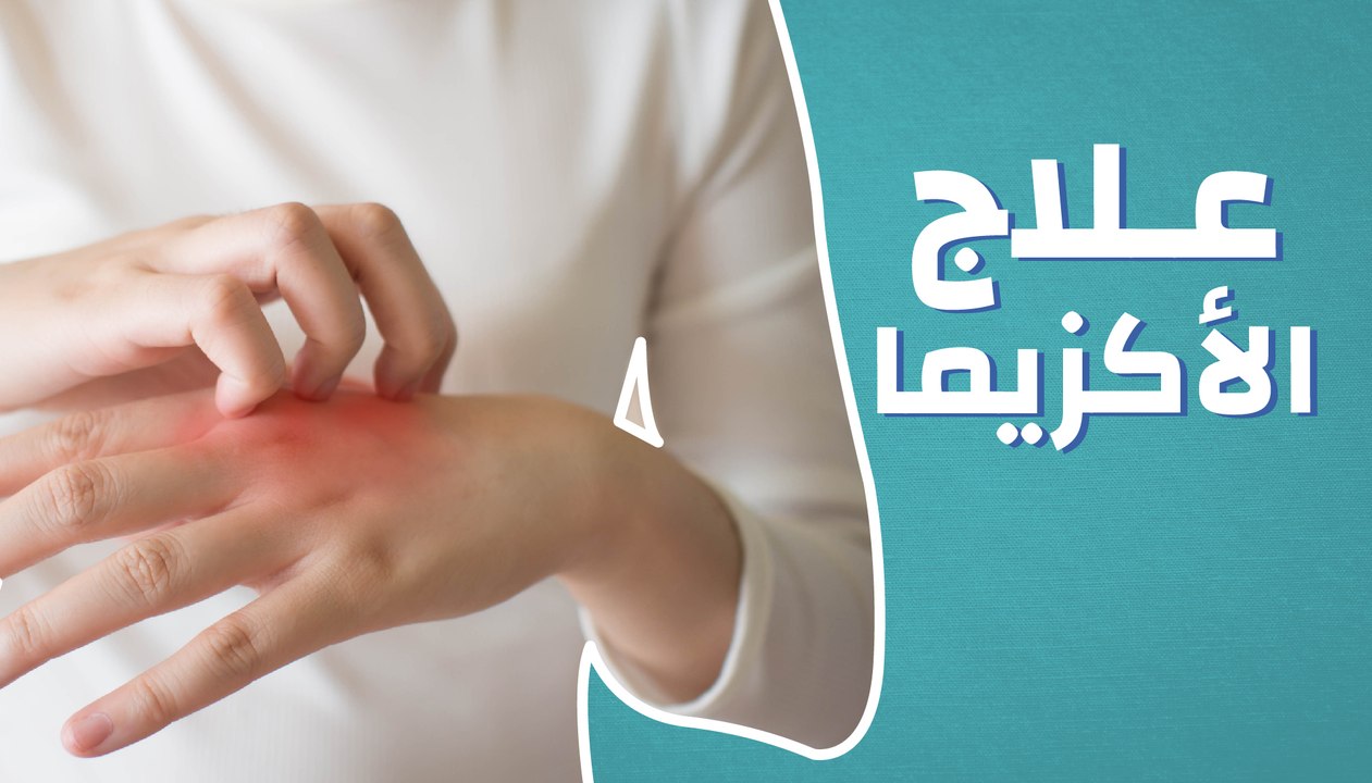 علاج الاكزيما