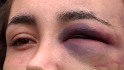 Rebeca, la joven que fue agredida por su pareja.