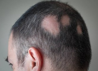 Alopecia: Ursachen und Haarausfall erklärt