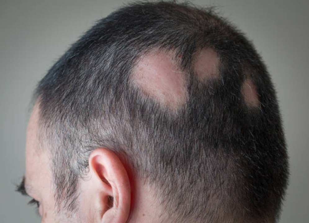 ¿Qué es la Alopecia?