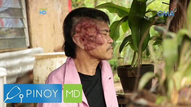 Pinoy MD: Malaking bukol, tila nilamon ang mukha ng isang lalaki!